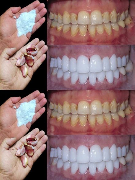 How to whiten your teeth in 2 minutes?