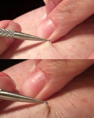 A man discovered a black spot on his leg and began to peel it off. What he removed left millions speechless.